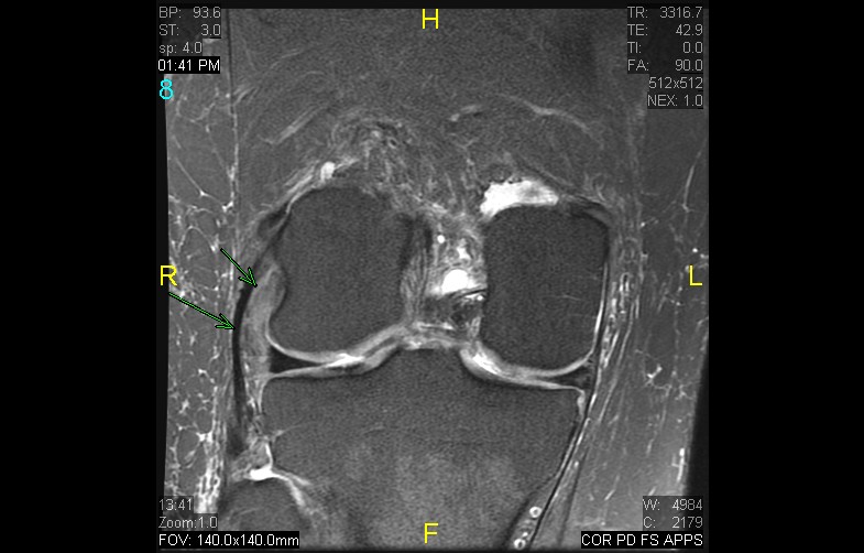 Figure 5 for case Popliteus tendinosis